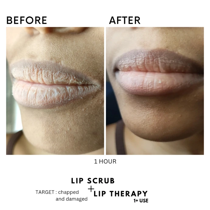 Dry and chapped lips recovery